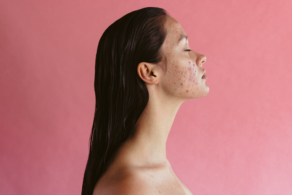 woman with acne