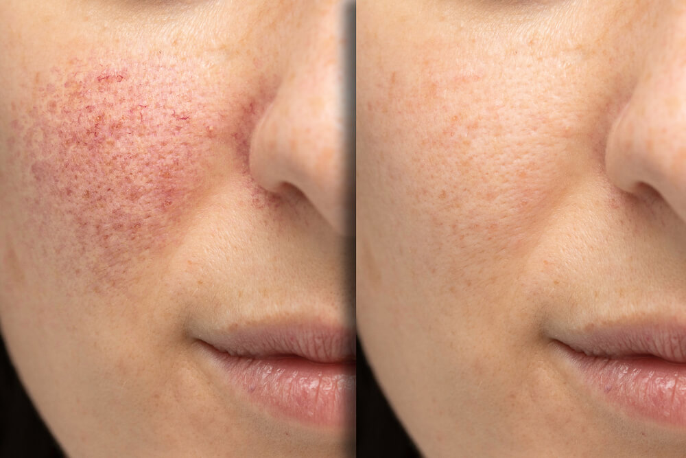 Have Acne Rosacea? 7 Things You Can Do For It