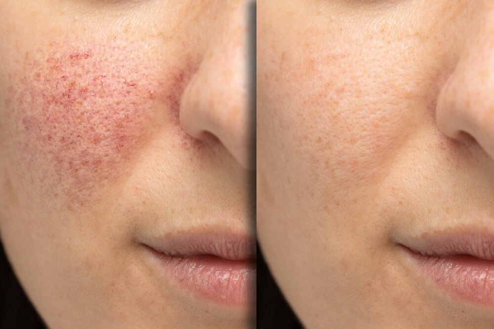 acne rosacea